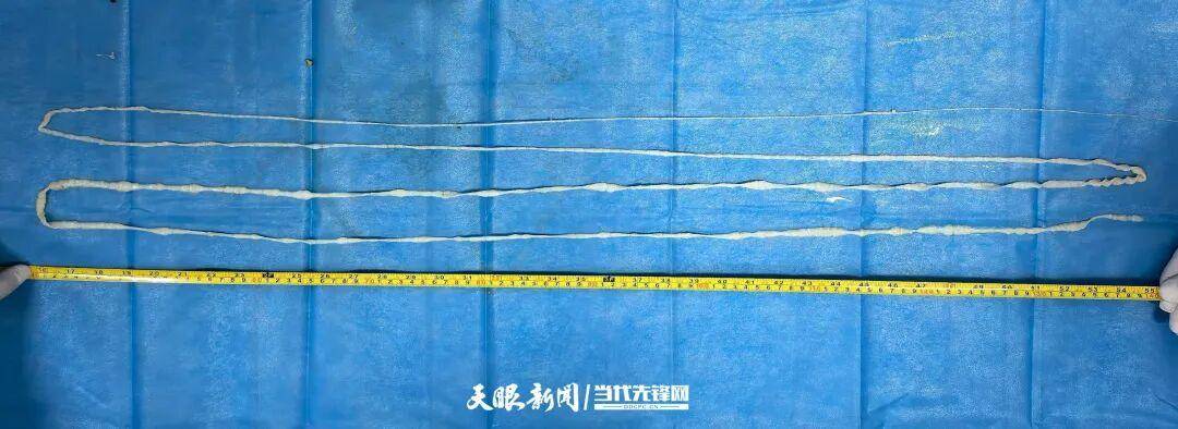 山口雷法 vs 千叶市原_最长4米！贵州一男子连续7个月排出“面条状异物”山口雷法 vs 千叶市原，医生：很可能和吃这种生食有关