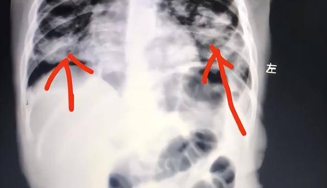 世界杯皇冠信用平台_1岁宝宝误食紫草油病危：宝妈错误手抠催吐 肺已全白